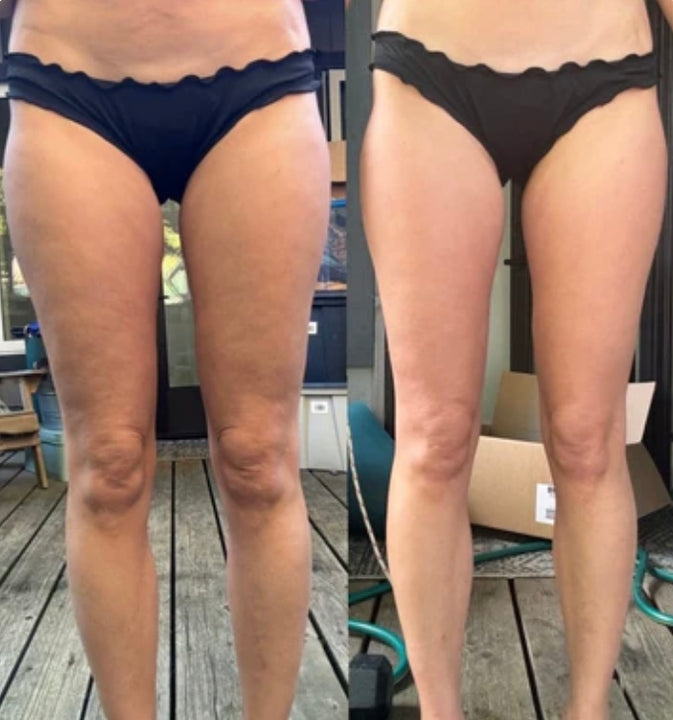 Massageador Elétrico Anticelulite